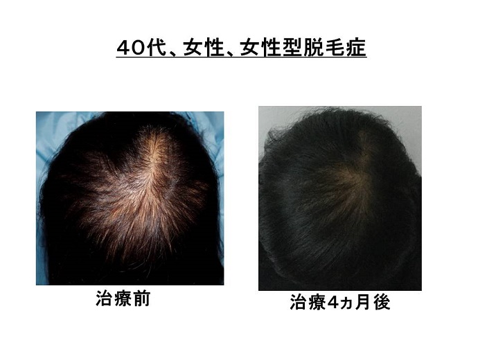 円形脱毛症　病院